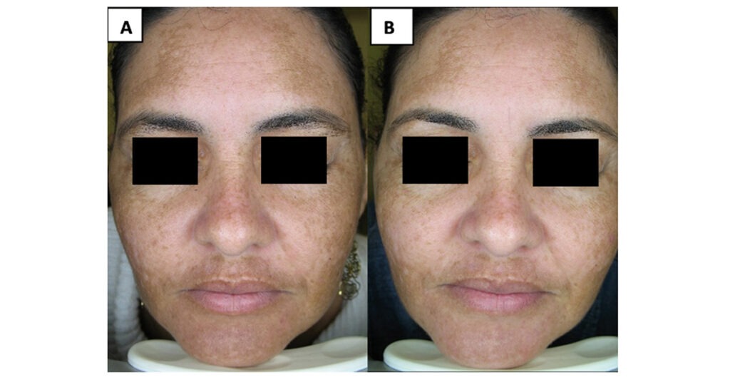 Tratamento para melasma