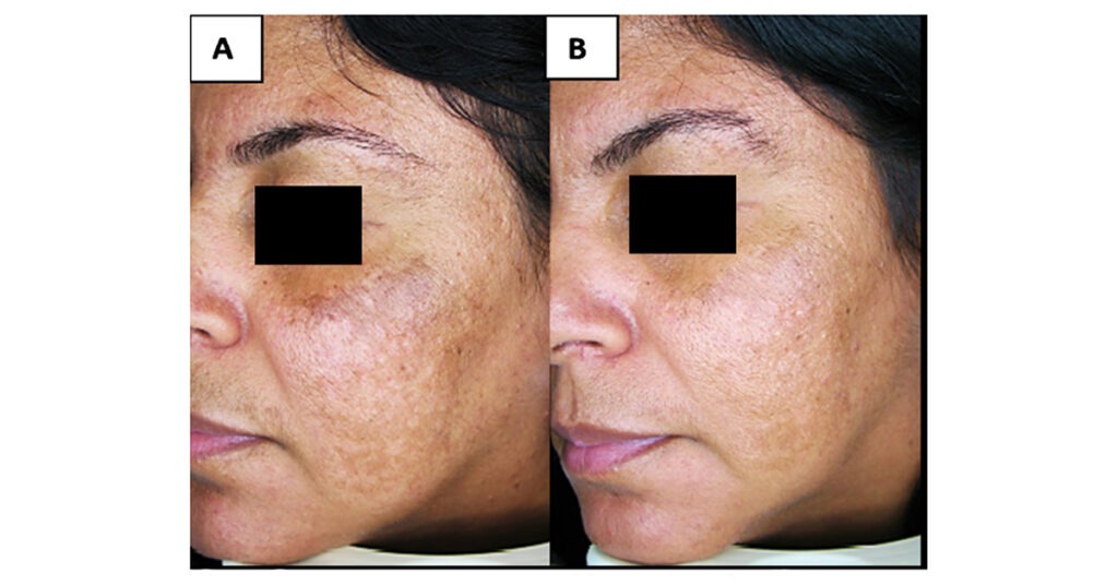 Participante de 36 anos com melasma recalcitrante há 19 anos antes do tratamento (A) e após (B) 60 dias de uso do tratamento oral contendo o extrato de oliva. 