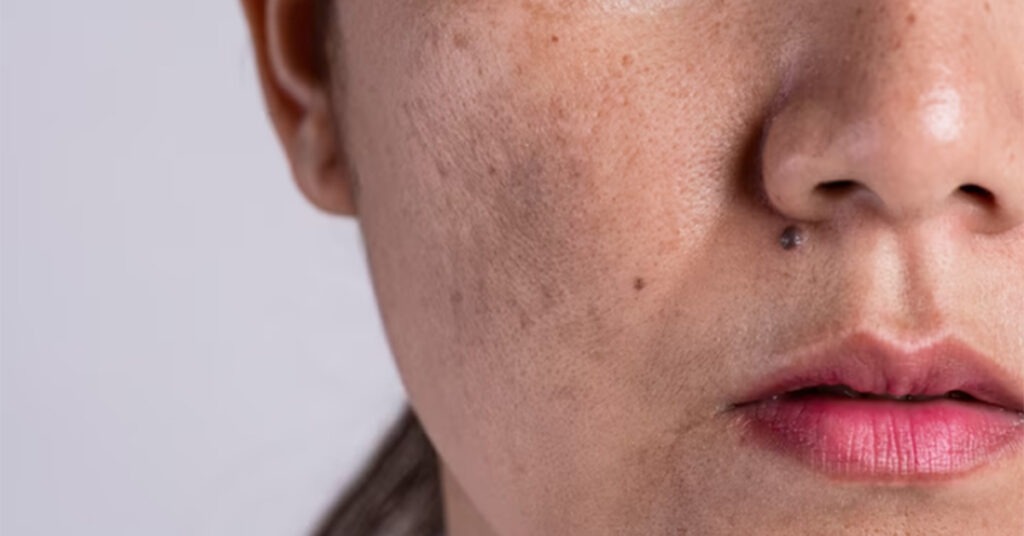 Tratamento para melasma