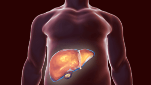 O papel da Vitamina D na doença hepática gordurosa não alcoólica (DHGNA)